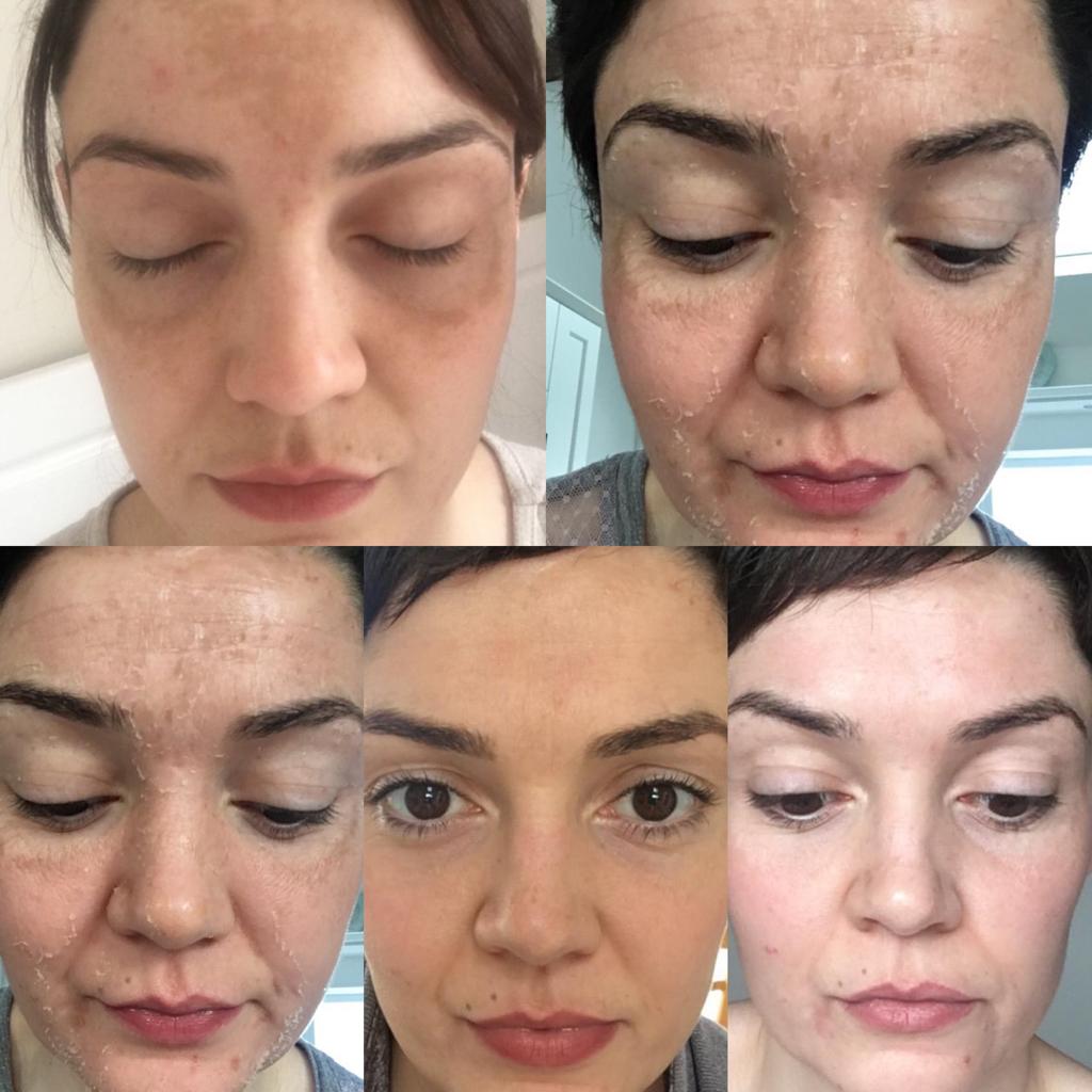 Pigment Peel